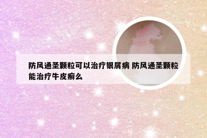 防风通圣颗粒可以治疗银屑病 防风通圣颗粒能治疗牛皮癣么
