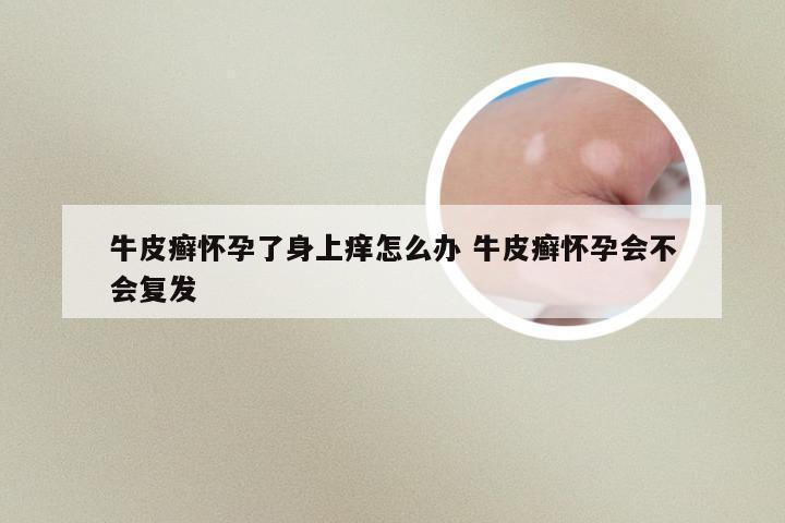 牛皮癣怀孕了身上痒怎么办 牛皮癣怀孕会不会复发