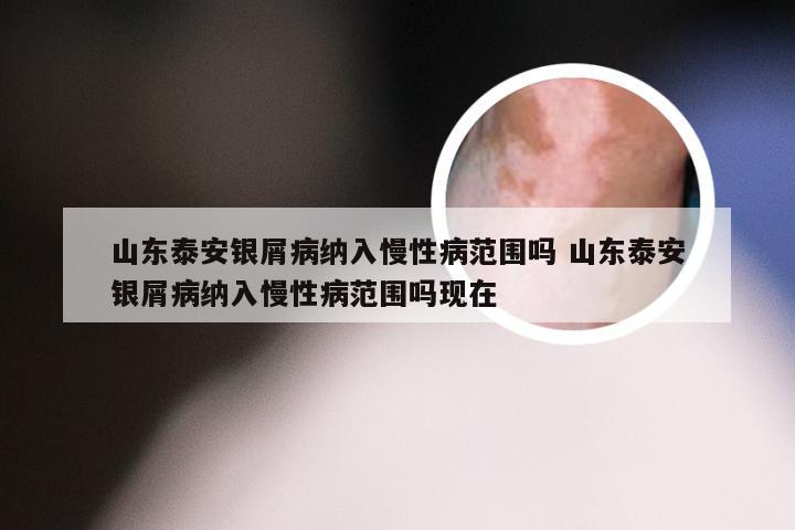 山东泰安银屑病纳入慢性病范围吗 山东泰安银屑病纳入慢性病范围吗现在
