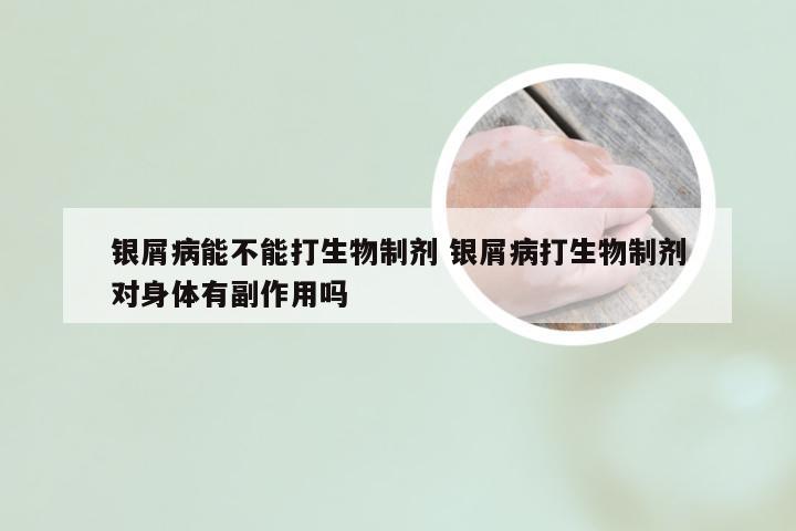 银屑病能不能打生物制剂 银屑病打生物制剂对身体有副作用吗