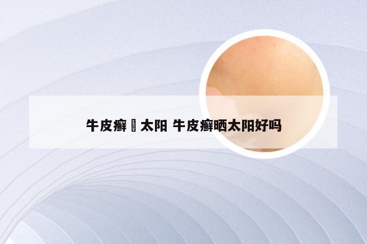 牛皮癣嗮太阳 牛皮癣晒太阳好吗