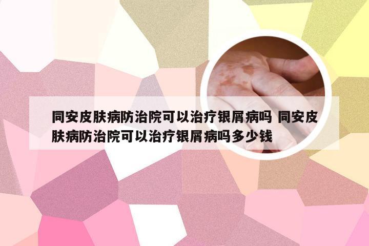 同安皮肤病防治院可以治疗银屑病吗 同安皮肤病防治院可以治疗银屑病吗多少钱