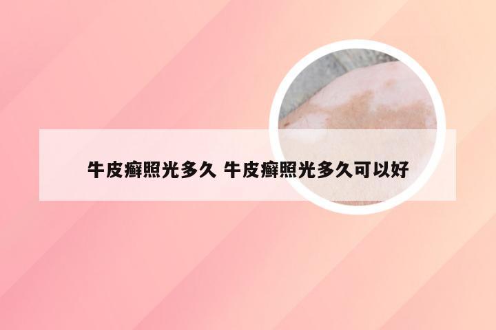 牛皮癣照光多久 牛皮癣照光多久可以好