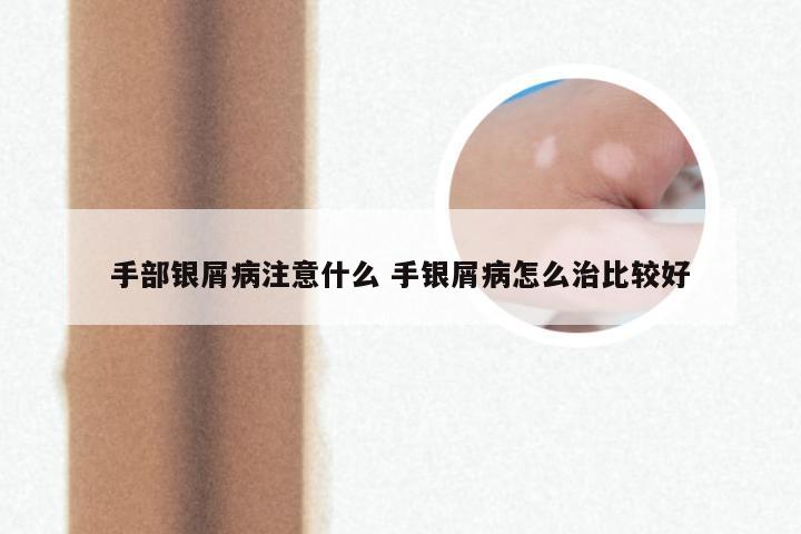 手部银屑病注意什么 手银屑病怎么治比较好
