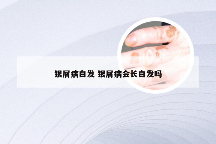银屑病白发 银屑病会长白发吗