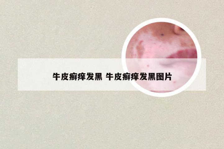 牛皮癣痒发黑 牛皮癣痒发黑图片