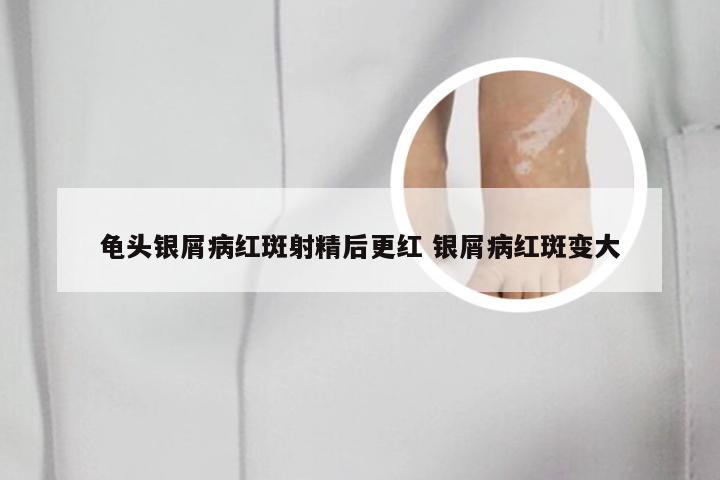 龟头银屑病红斑射精后更红 银屑病红斑变大