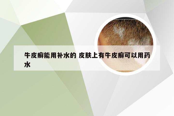 牛皮癣能用补水的 皮肤上有牛皮癣可以用药水