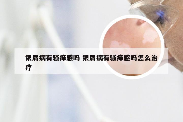 银屑病有骚痒感吗 银屑病有骚痒感吗怎么治疗