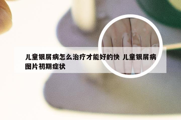 儿童银屑病怎么治疗才能好的快 儿童银屑病图片初期症状