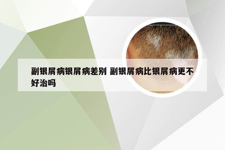 副银屑病银屑病差别 副银屑病比银屑病更不好治吗