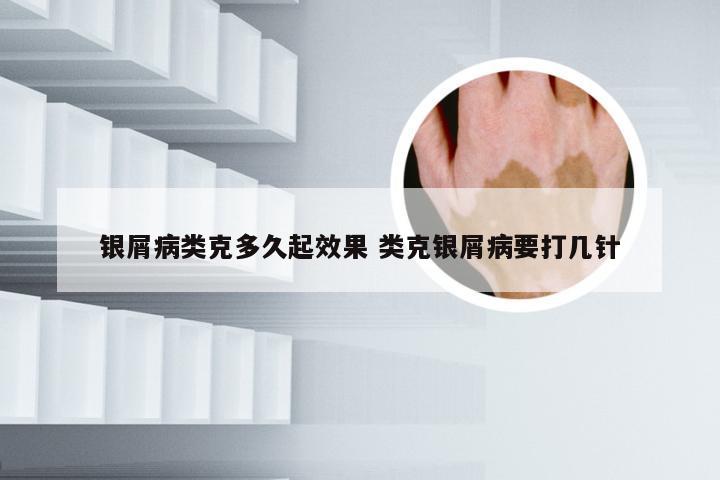 银屑病类克多久起效果 类克银屑病要打几针