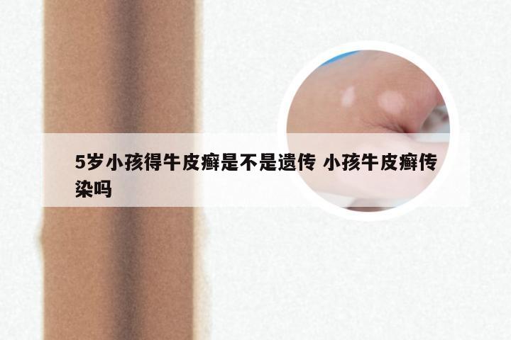 5岁小孩得牛皮癣是不是遗传 小孩牛皮癣传染吗
