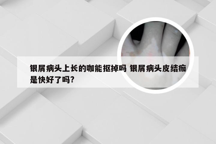 银屑病头上长的咖能抠掉吗 银屑病头皮结痂是快好了吗?