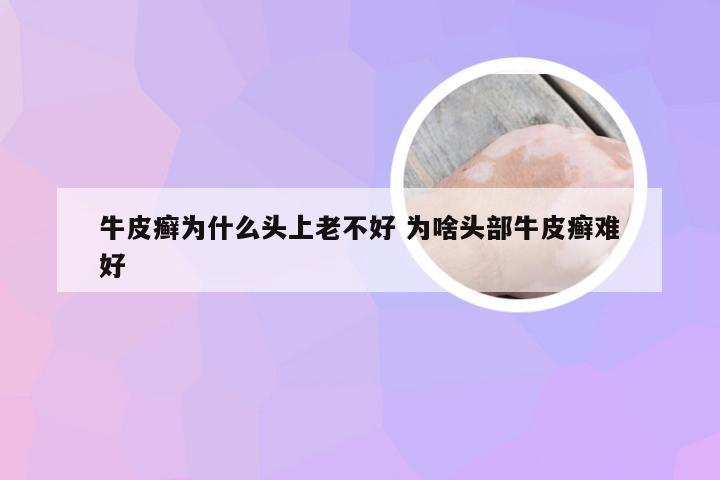 牛皮癣为什么头上老不好 为啥头部牛皮癣难好