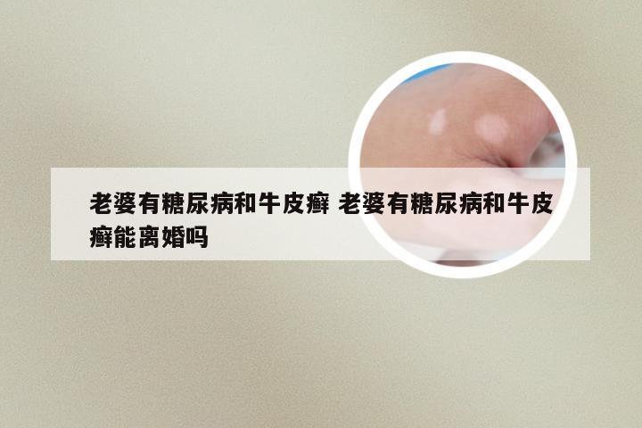 老婆有糖尿病和牛皮癣 老婆有糖尿病和牛皮癣能离婚吗
