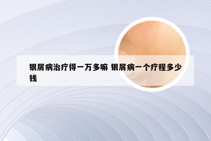 银屑病治疗得一万多嘛 银屑病一个疗程多少钱