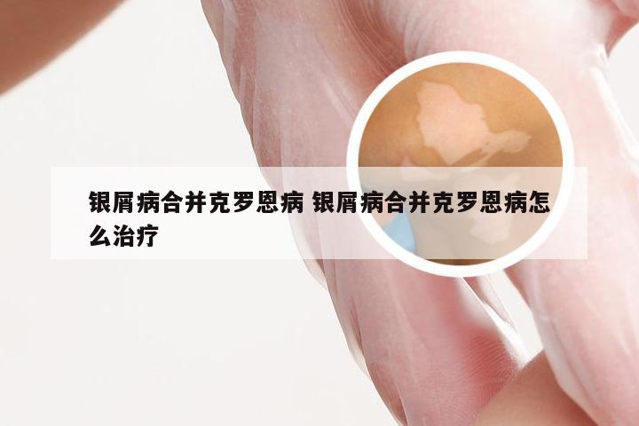 银屑病合并克罗恩病 银屑病合并克罗恩病怎么治疗