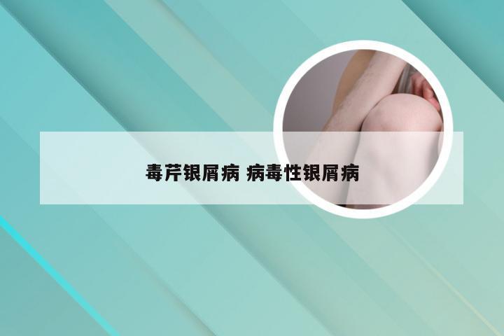 毒芹银屑病 病毒性银屑病
