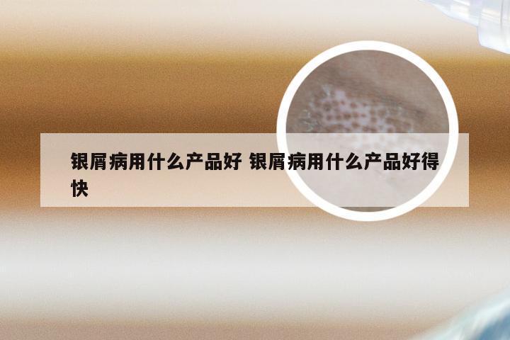 银屑病用什么产品好 银屑病用什么产品好得快