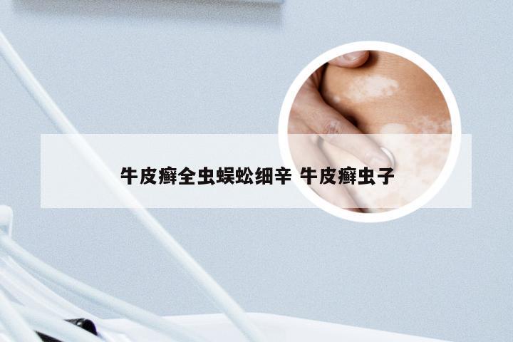 牛皮癣全虫蜈蚣细辛 牛皮癣虫子