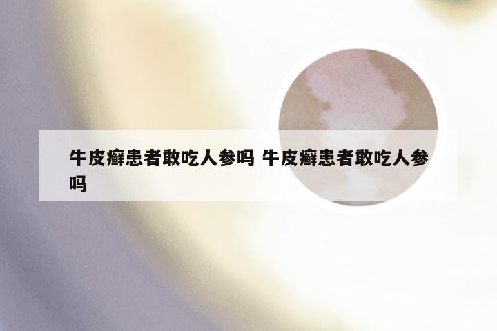 牛皮癣患者敢吃人参吗 牛皮癣患者敢吃人参吗