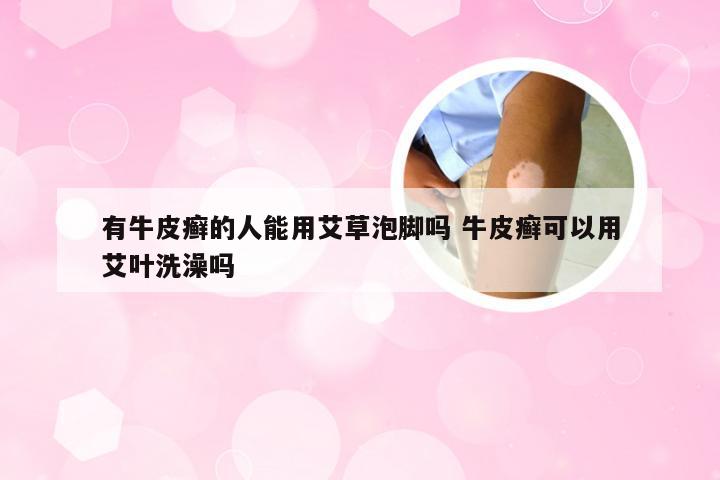 有牛皮癣的人能用艾草泡脚吗 牛皮癣可以用艾叶洗澡吗