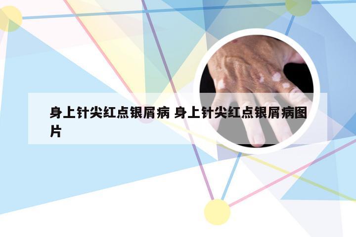 身上针尖红点银屑病 身上针尖红点银屑病图片