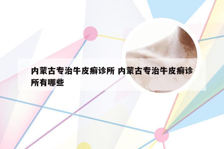 内蒙古专治牛皮癣诊所 内蒙古专治牛皮癣诊所有哪些