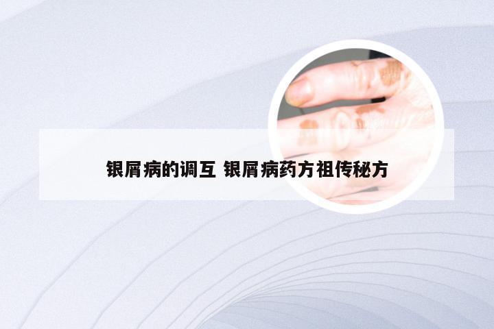 银屑病的调互 银屑病药方祖传秘方