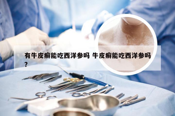有牛皮癣能吃西洋参吗 牛皮癣能吃西洋参吗?