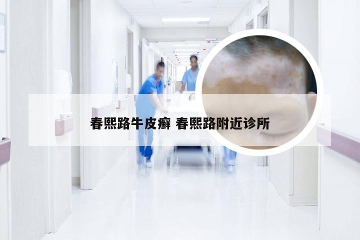 春熙路牛皮癣 春熙路附近诊所