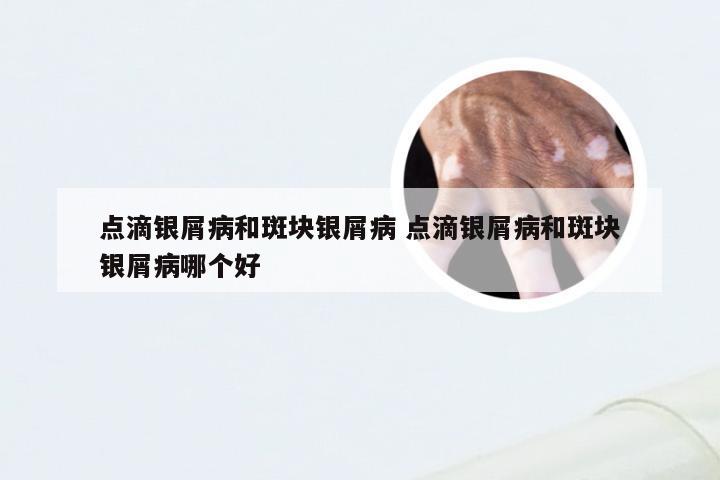 点滴银屑病和斑块银屑病 点滴银屑病和斑块银屑病哪个好