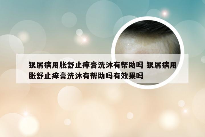 银屑病用胀舒止痒膏洗沐有帮助吗 银屑病用胀舒止痒膏洗沐有帮助吗有效果吗