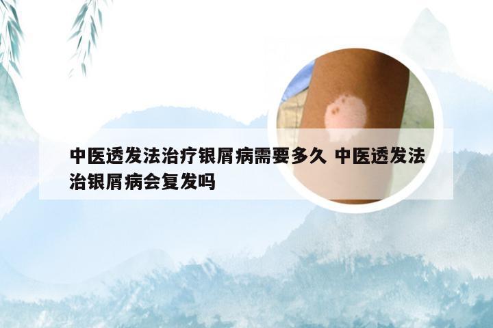 中医透发法治疗银屑病需要多久 中医透发法治银屑病会复发吗