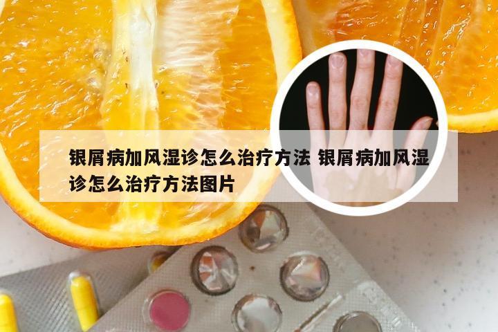 银屑病加风湿诊怎么治疗方法 银屑病加风湿诊怎么治疗方法图片