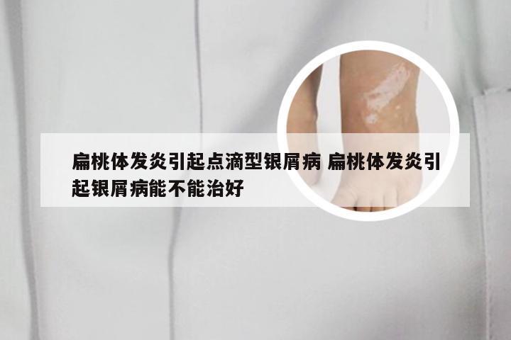 扁桃体发炎引起点滴型银屑病 扁桃体发炎引起银屑病能不能治好