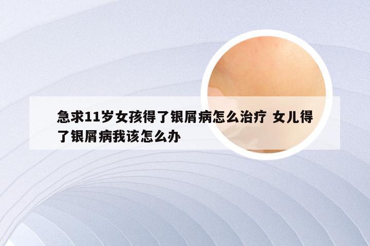 急求11岁女孩得了银屑病怎么治疗 女儿得了银屑病我该怎么办