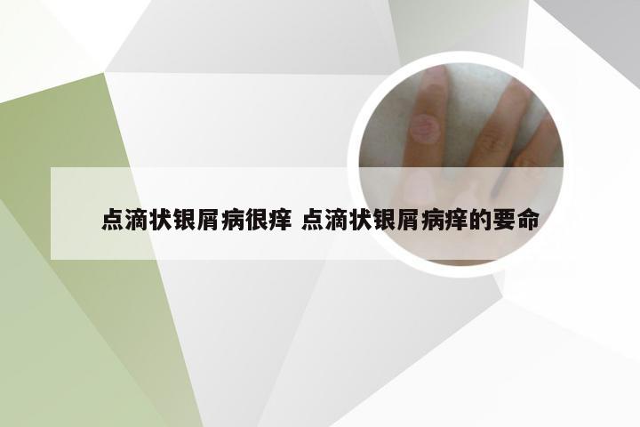 点滴状银屑病很痒 点滴状银屑病痒的要命