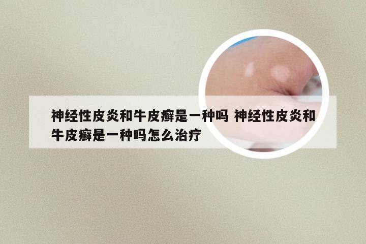 神经性皮炎和牛皮癣是一种吗 神经性皮炎和牛皮癣是一种吗怎么治疗