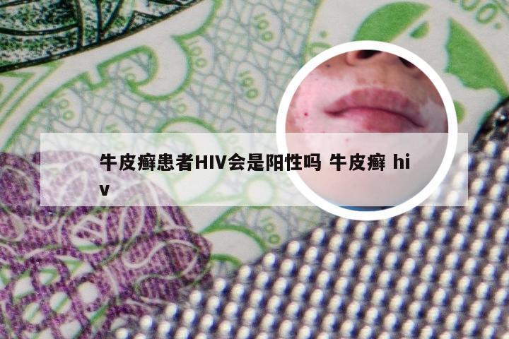 牛皮癣患者HIV会是阳性吗 牛皮癣 hiv