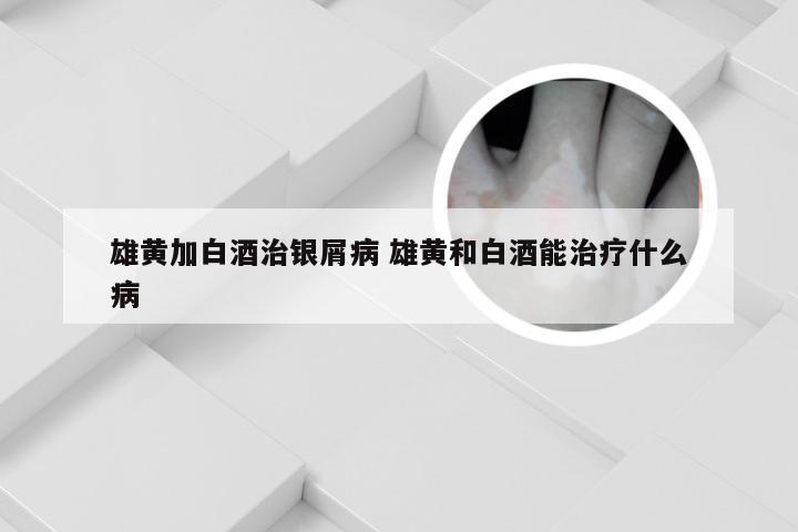 雄黄加白酒治银屑病 雄黄和白酒能治疗什么病