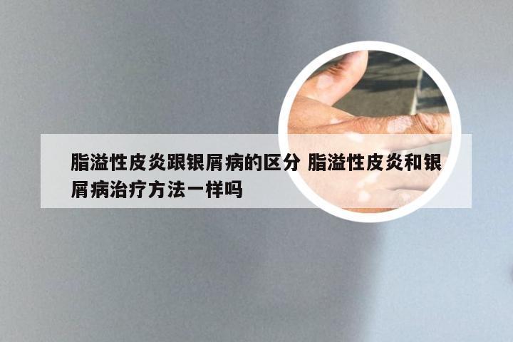 脂溢性皮炎跟银屑病的区分 脂溢性皮炎和银屑病治疗方法一样吗