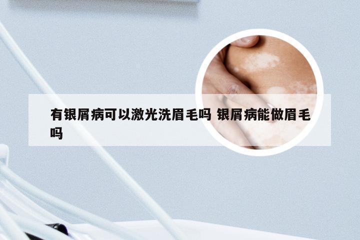 有银屑病可以激光洗眉毛吗 银屑病能做眉毛吗