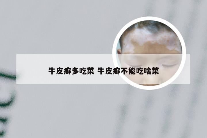 牛皮癣多吃菜 牛皮癣不能吃啥菜