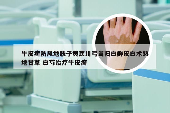 牛皮癣防风地肤子黄芪川弓当归白鲜皮白术熟地甘草 白芍治疗牛皮癣