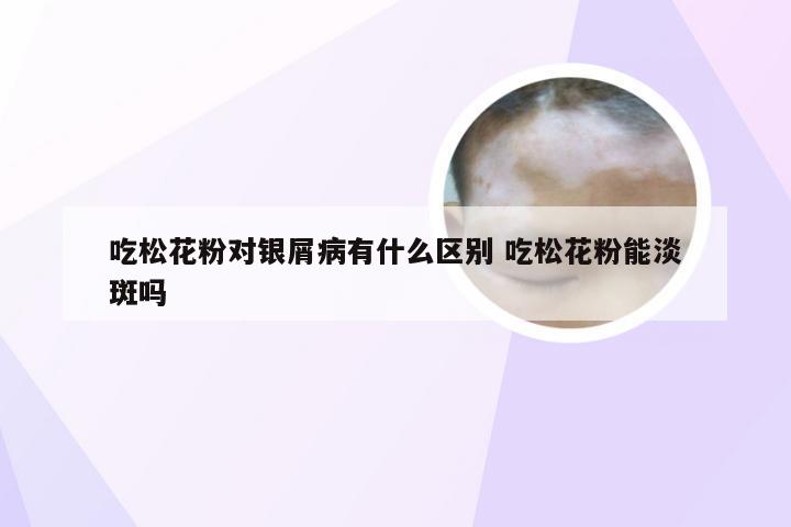 吃松花粉对银屑病有什么区别 吃松花粉能淡斑吗