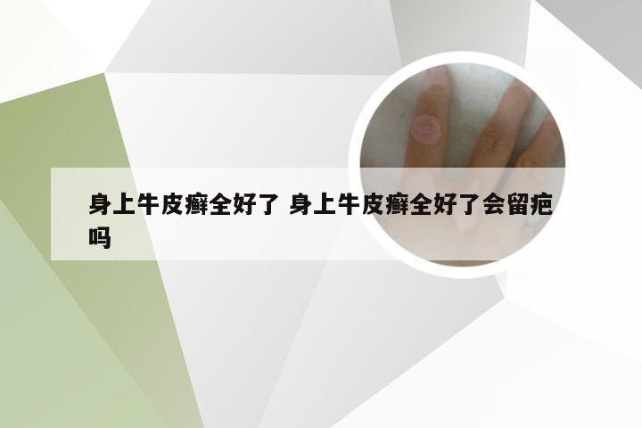 身上牛皮癣全好了 身上牛皮癣全好了会留疤吗