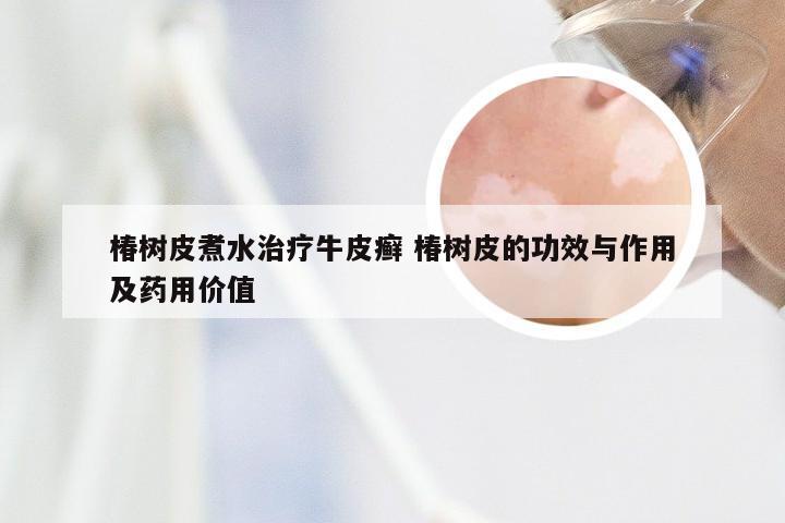 椿树皮煮水治疗牛皮癣 椿树皮的功效与作用及药用价值
