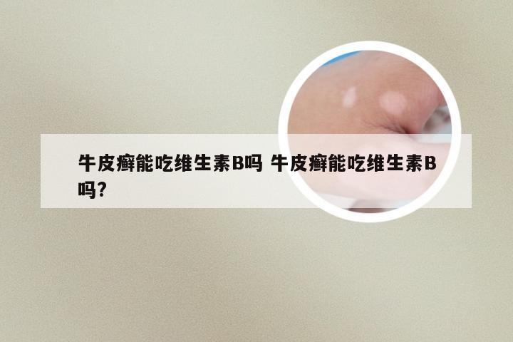 牛皮癣能吃维生素B吗 牛皮癣能吃维生素B吗?